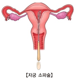 계류유산으로_인한_자궁소파술.jpg