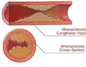 coronary.jpg