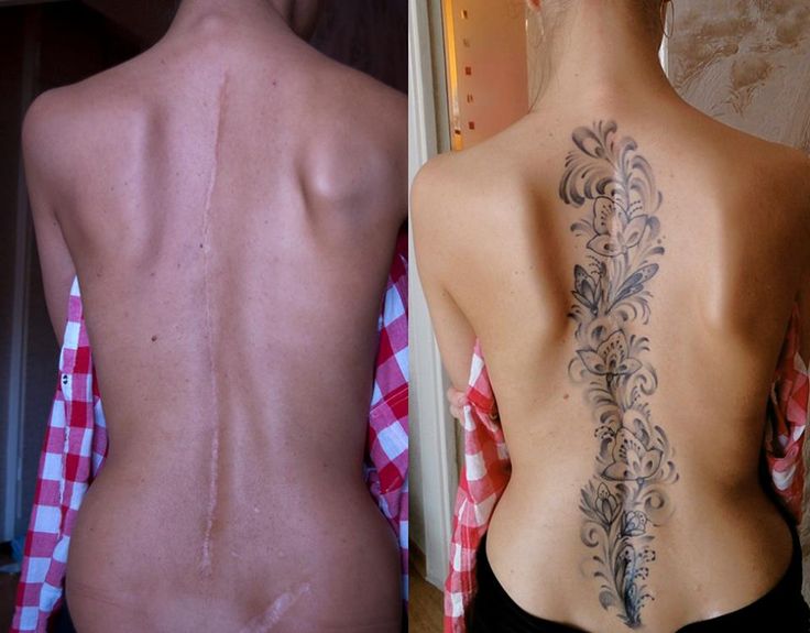 scolisois-tattoo-cover-up.jpg