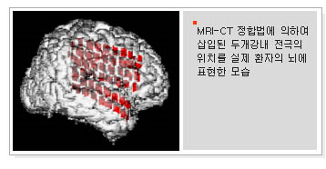 뇌전극.png